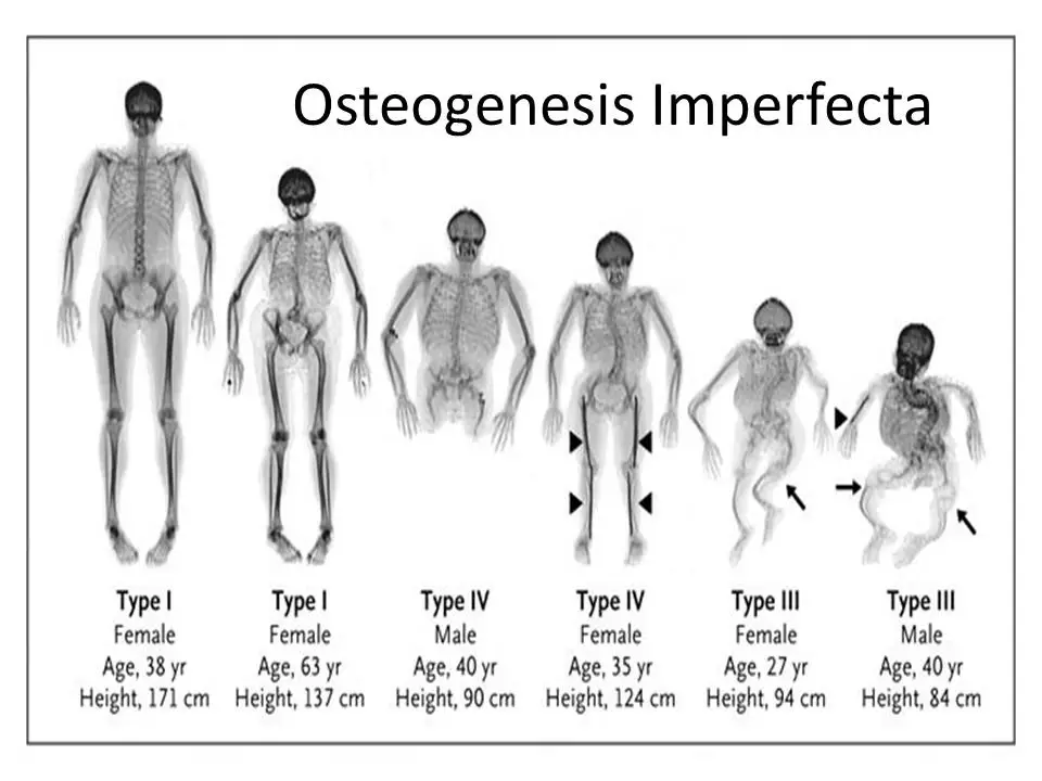 Clinical manifestation of Osteogenesis imperfecta